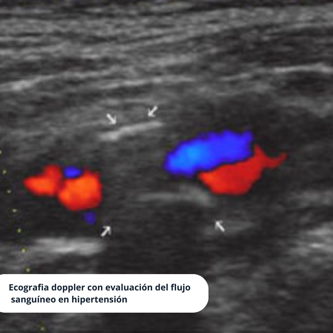 Ecografía doppler con evaluación de flujo sanguineo en hipertensión