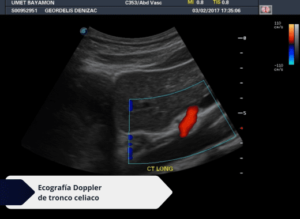 Ecografía Doppler de Tronco Celiaco Ecodoppler Vascular I Doppler en