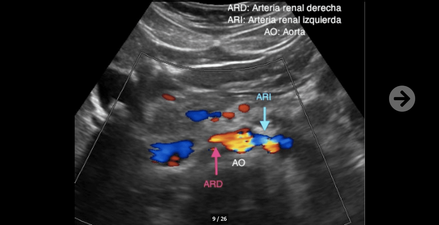 Ecograf A Doppler De Arterias Renales Ecodoppler Vascular