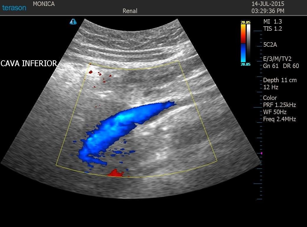 Ecografía Doppler de vena cava - Ecodoppler Vascular Bogot