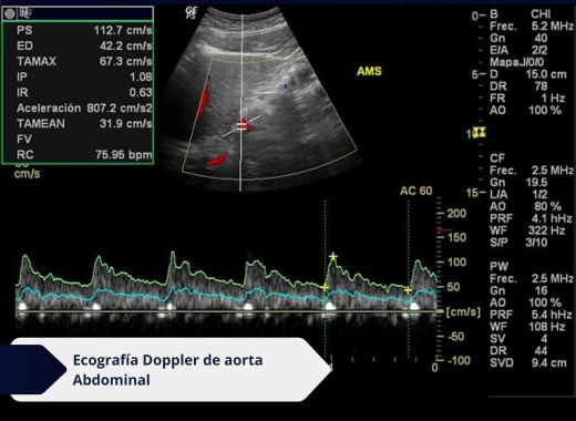 eco-doppler-de-aorta-abdominal- Ecodoppler vascular en Bogotá 1