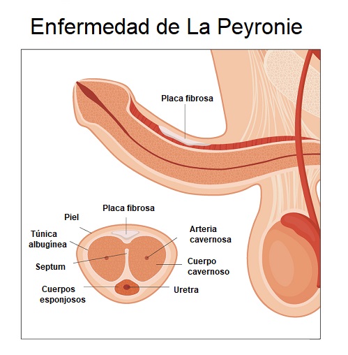 Diagnóstico de la enfermedad de Peyronie con Doppler Peneano en Bogotá