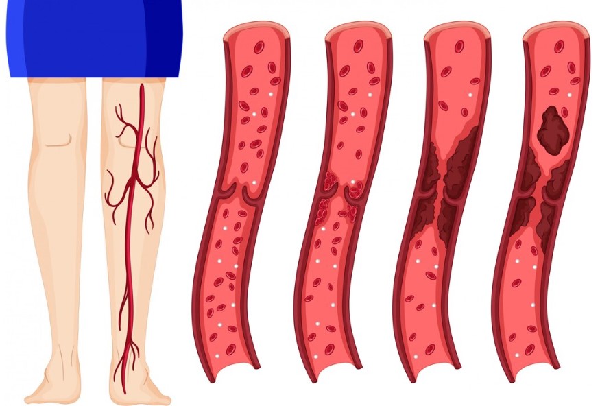 Enfermedad arterial periferica