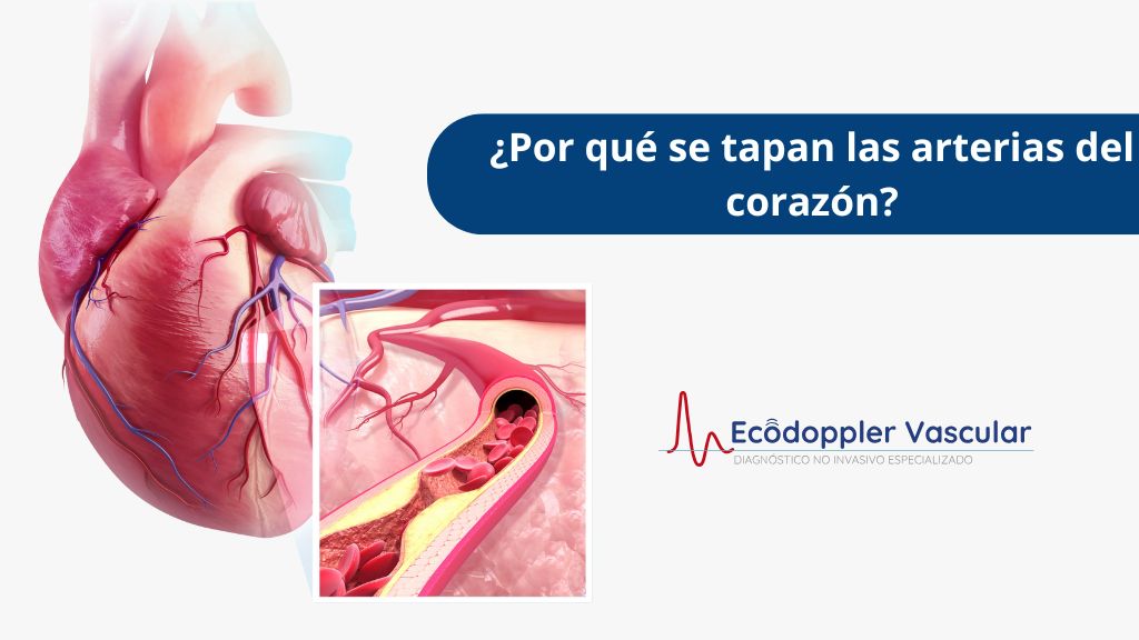 Por qué se tapan las arterias del corazón - Ecografía Doppler en Bogotá - Ecodoppler Vascular