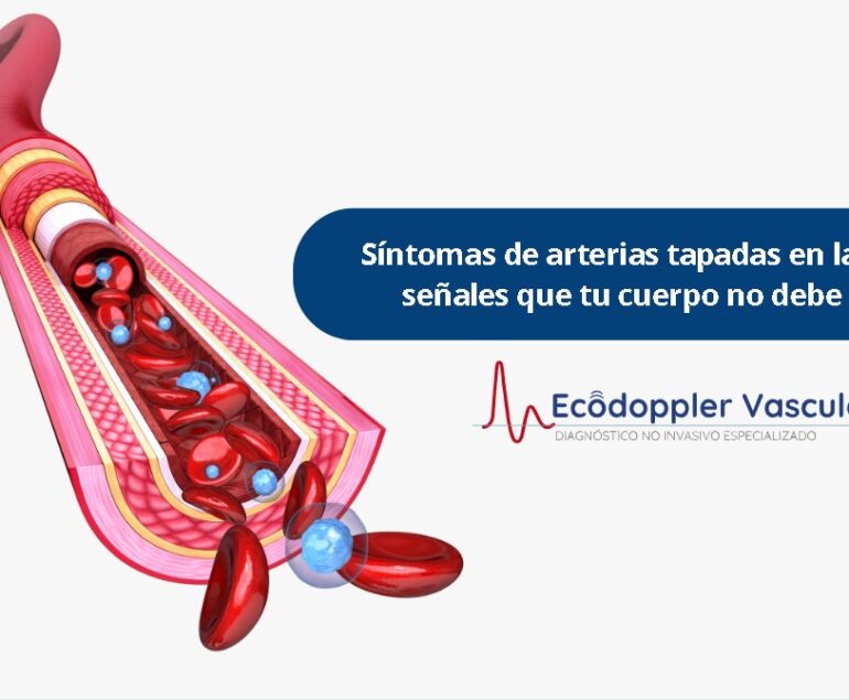 Síntomas de arterias tapadas en las piernas- Ecodoppler