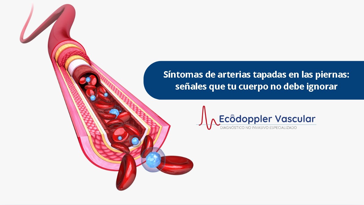 Síntomas de arterias tapadas en las piernas- Ecodoppler