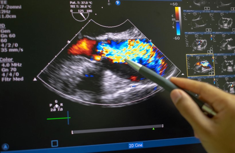 Doppler aorta abdominal-Ecodoppler