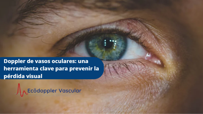 Doppler de vasos oculares-Ecodoppler