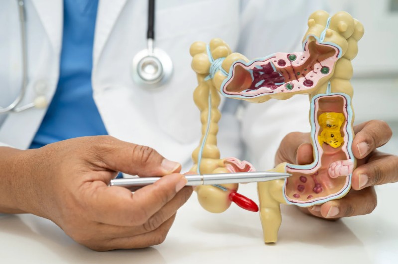 Enfermedad digestiva por dolor abdominal crónico detectado con ecografía doppler mesentérico - Ecodoppler Vascular