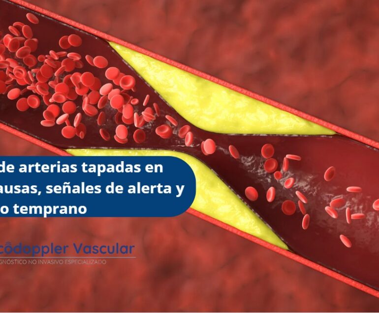 Síntomas de arterias tapadas en piernas-Ecodoppler