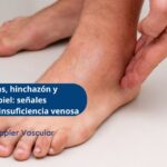 Síntomas de insuficiencia crónica en Bogotá - Ecodoppler Vascular