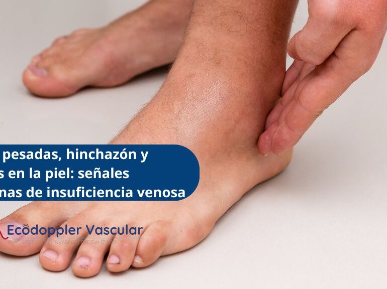 Síntomas de insuficiencia crónica en Bogotá - Ecodoppler Vascular