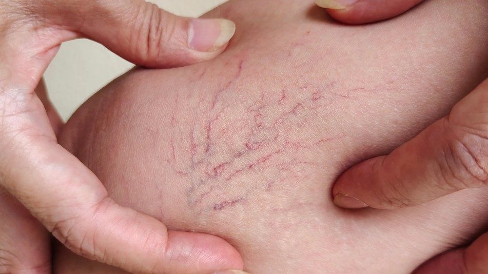 Várices y venas inflamadas-Ecodoppler