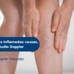 Várices y venas inflamadas-Ecodoppler