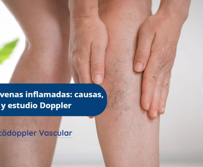 Várices y venas inflamadas-Ecodoppler