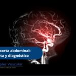 Aneurisma de aorta abdominal-Ecodoppler